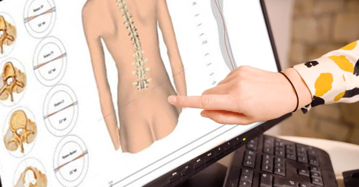 A person pointing at a scoliosis scan on a computer screen, indicating educational or medical research. | FCE Scan
